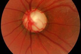 Glaucoma