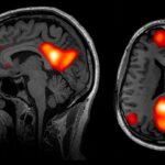 DMN resonancia magnética