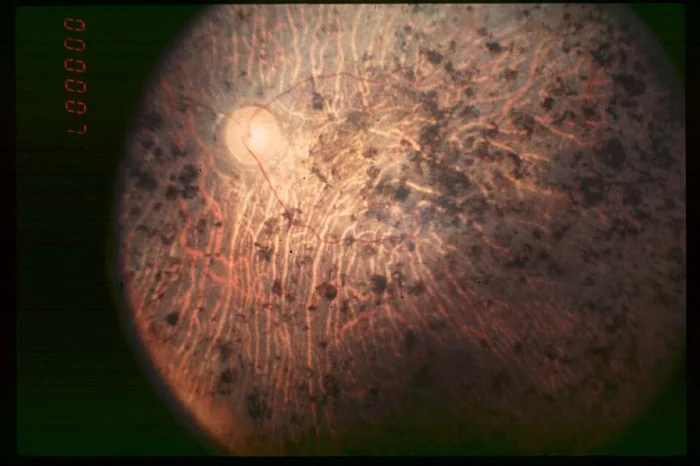 Fondo de ojo con retinitis pigmentosa avanzada, la enfermedad que tratan las primeras terapias optogenéticas